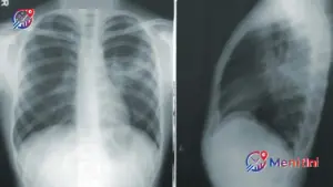 Indonesia Darurat TBC: Satu Nyawa Melayang Setiap 4 Menit, Pemerintah Gencarkan Deteksi Dini Masif