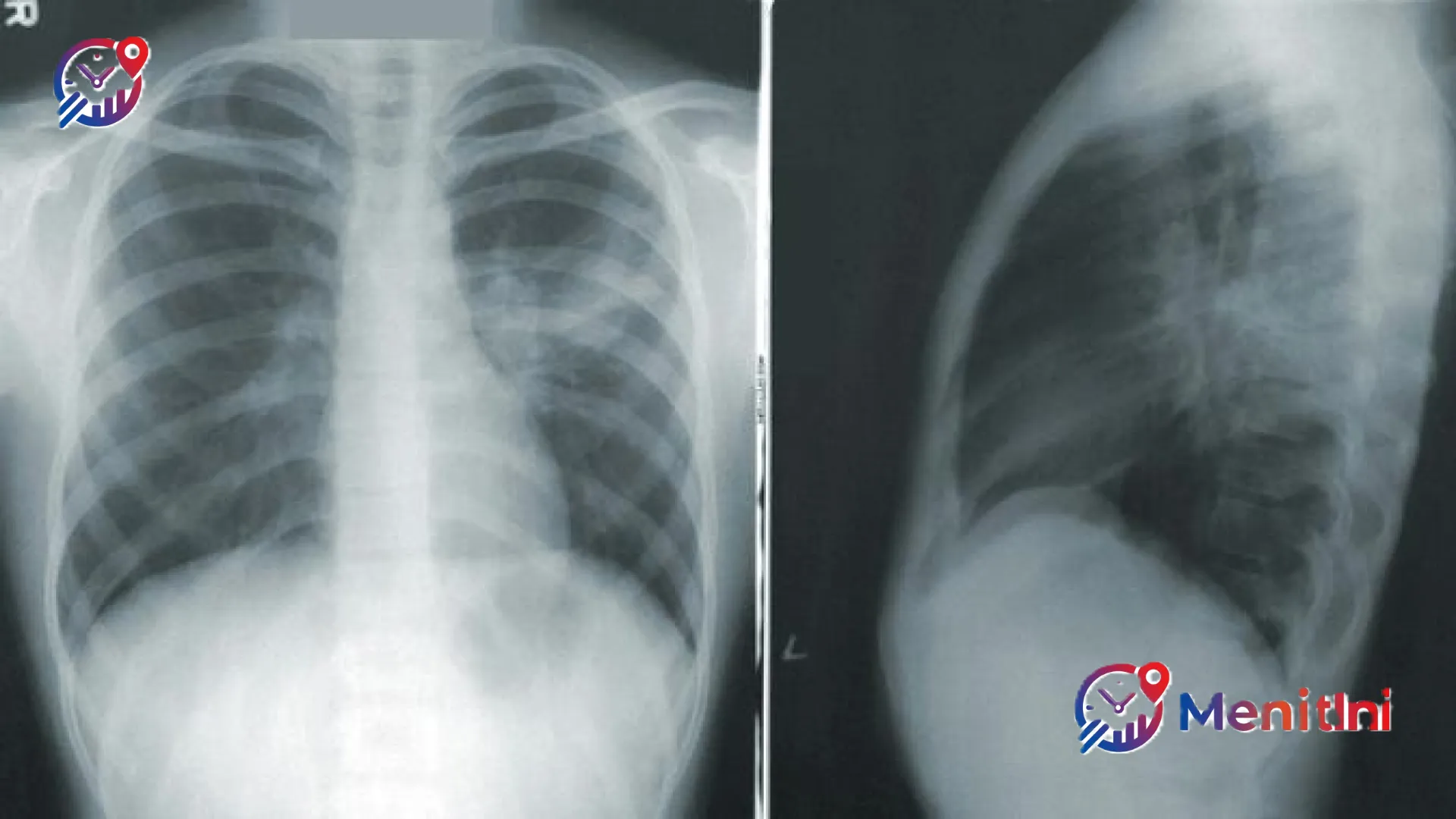 Indonesia Darurat TBC: Satu Nyawa Melayang Setiap 4 Menit, Pemerintah Gencarkan Deteksi Dini Masif